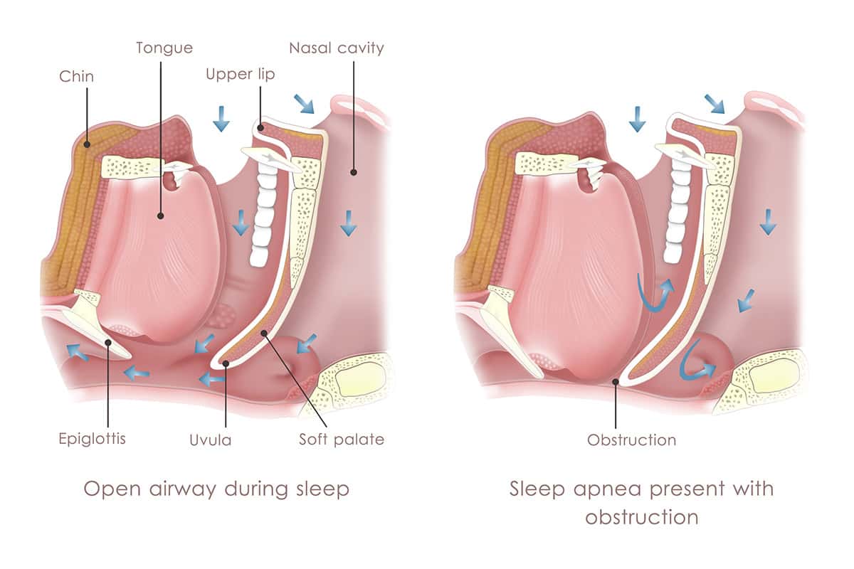 Tooth Extraction in 60453